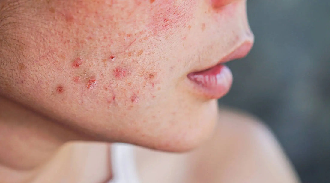 Spotlight on Acne | Blend Skin | Australian Skincare