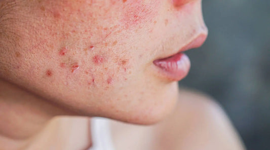 Spotlight on Acne | Blend Skin | Australian Skincare